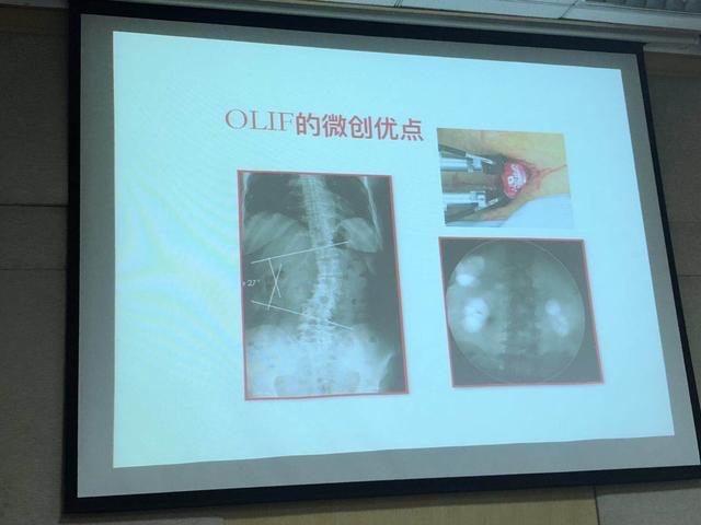 仅需40分钟！邵逸夫医院针对腰椎退行性病人有了更好的治疗方案